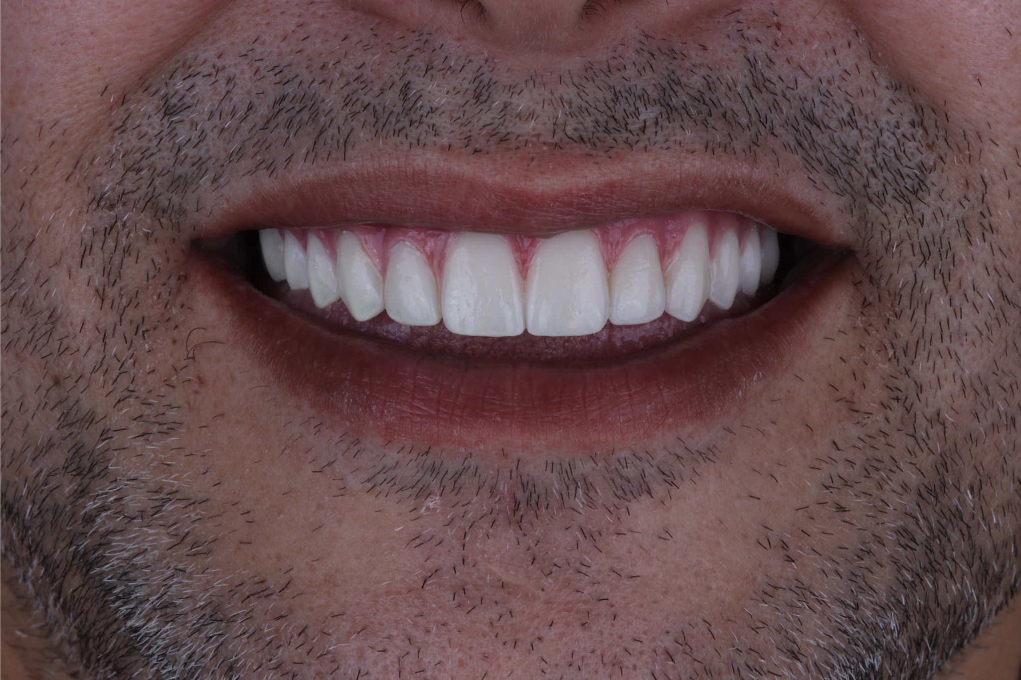 All on 4 — patient result — after