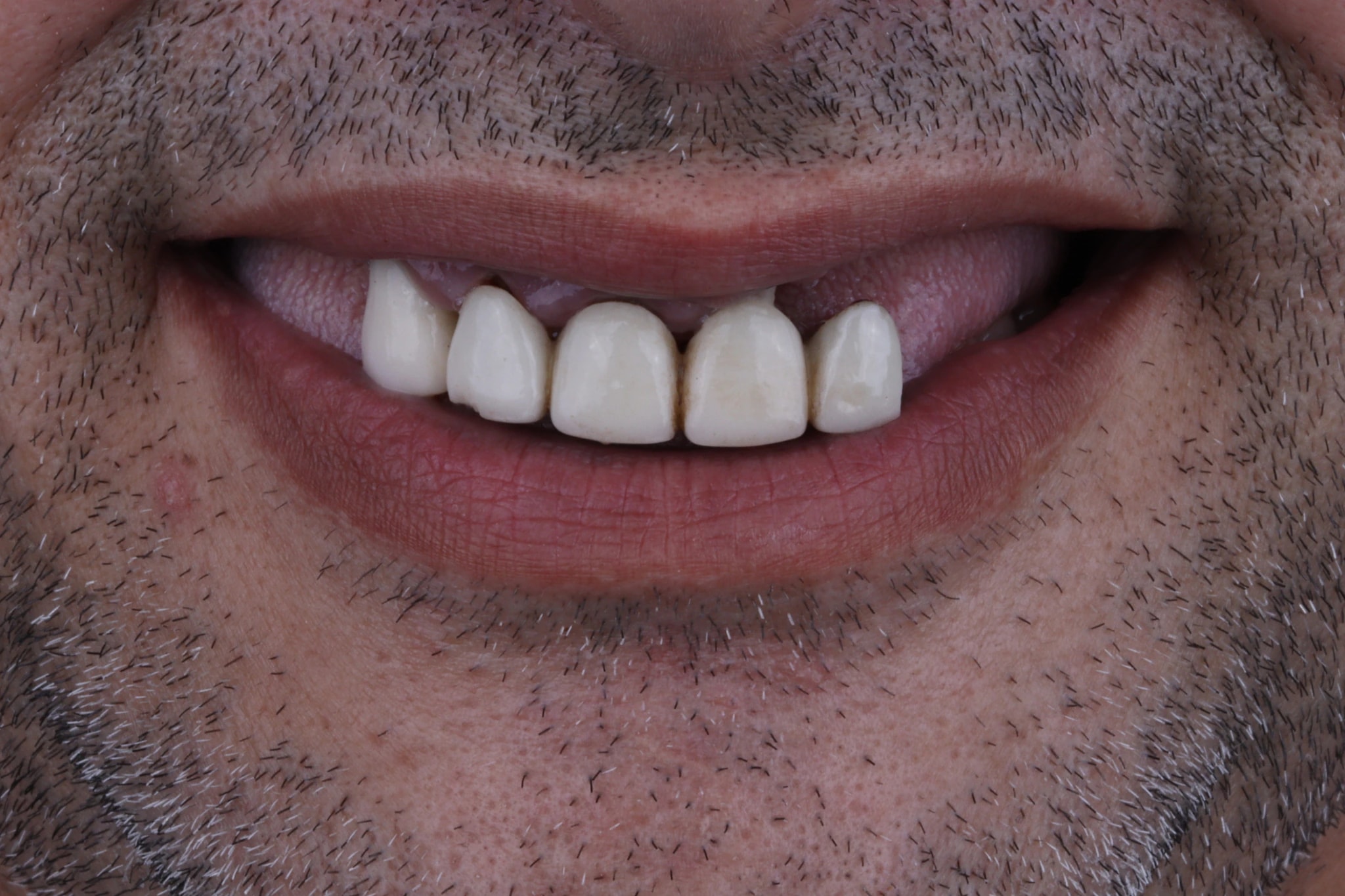 All on 4 — patient result — before