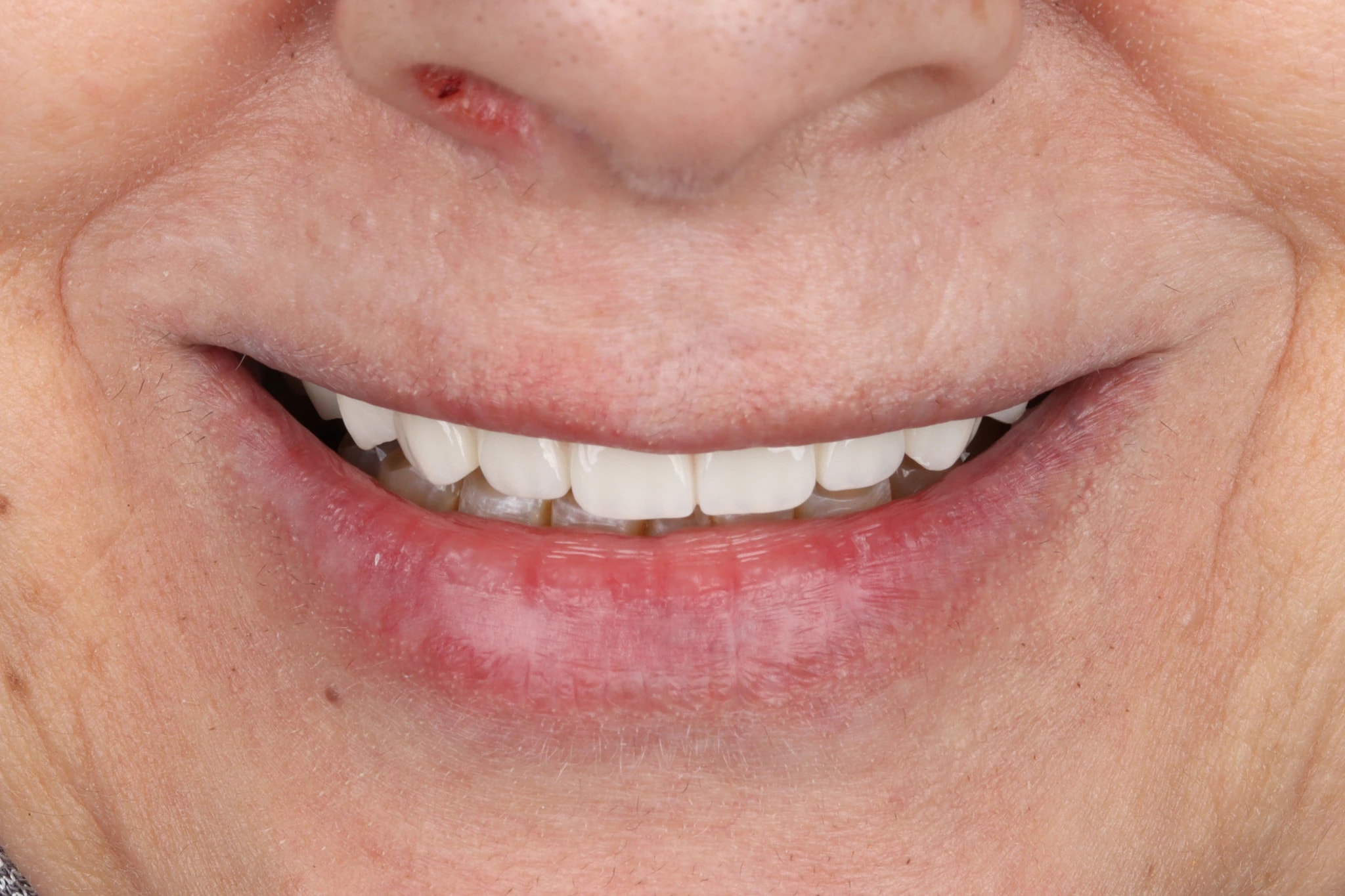 All on 4 — patient result — after