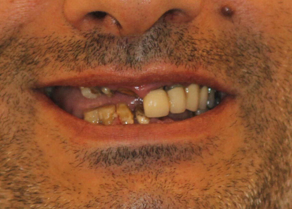 All on 4 — patient result — before