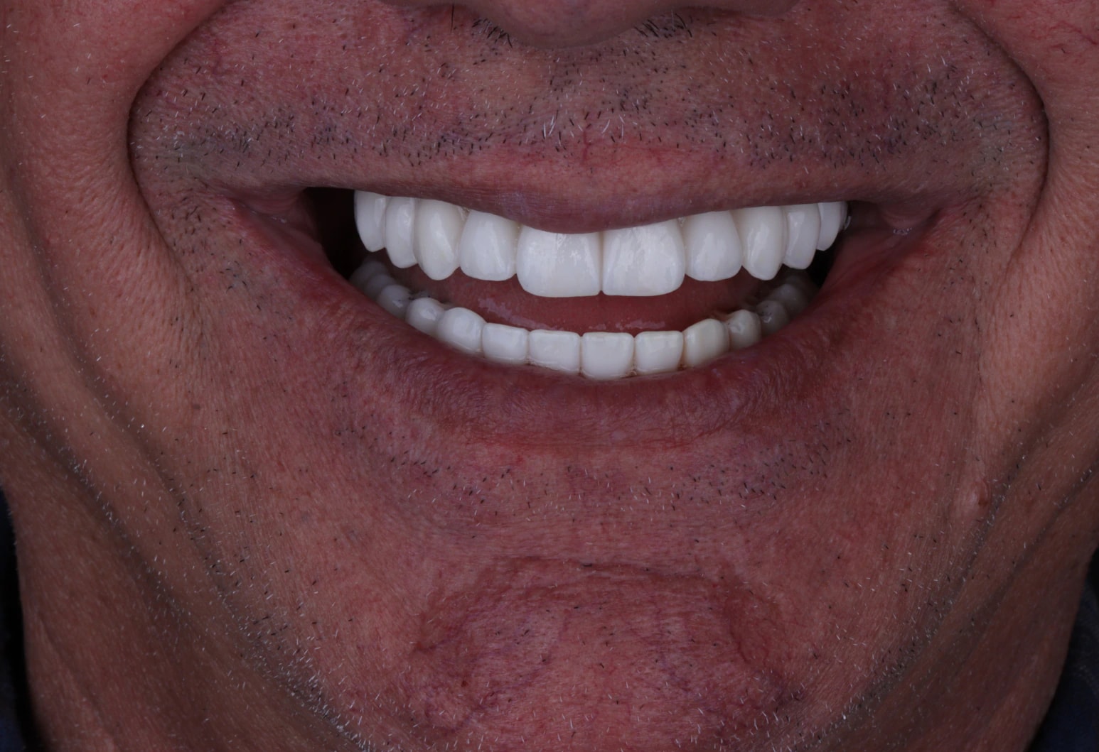 All on 4 — patient result — after