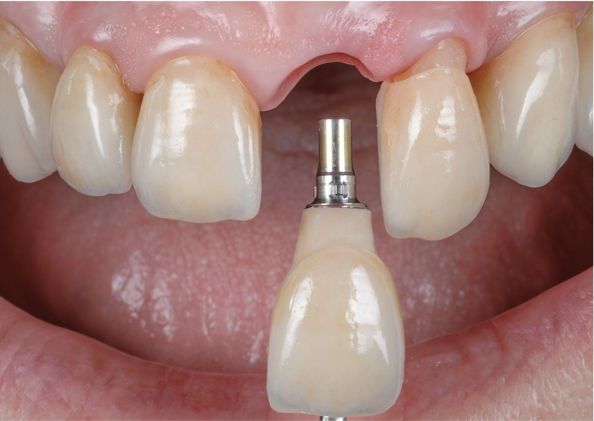 Dental Implant