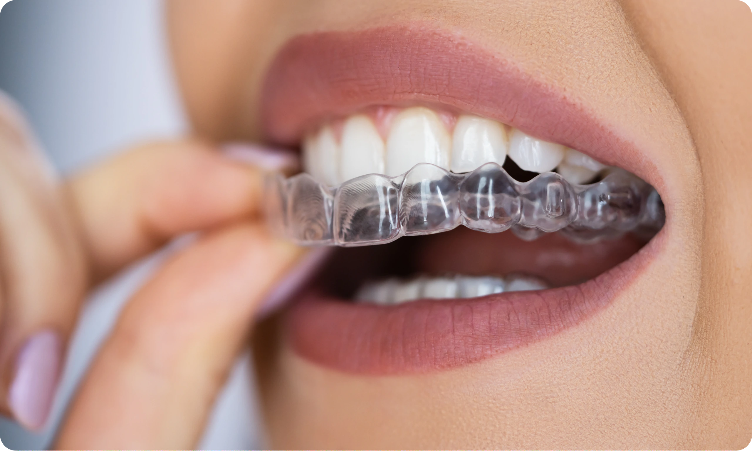Aligners