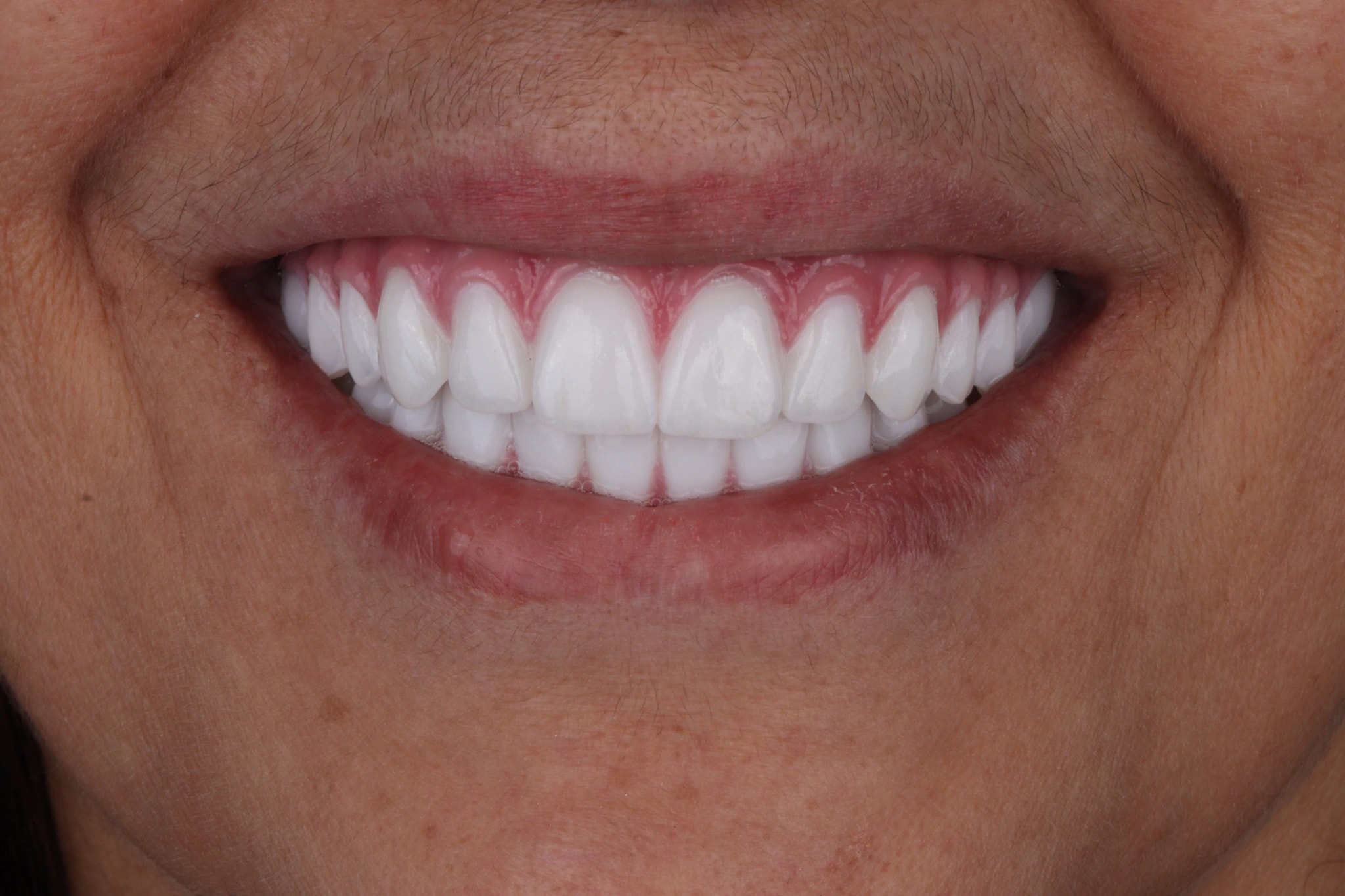All on 4 — patient result — after