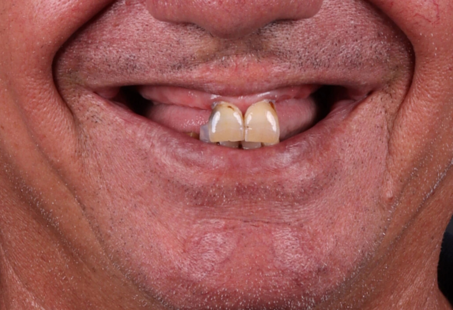 All on 4 — patient result — before