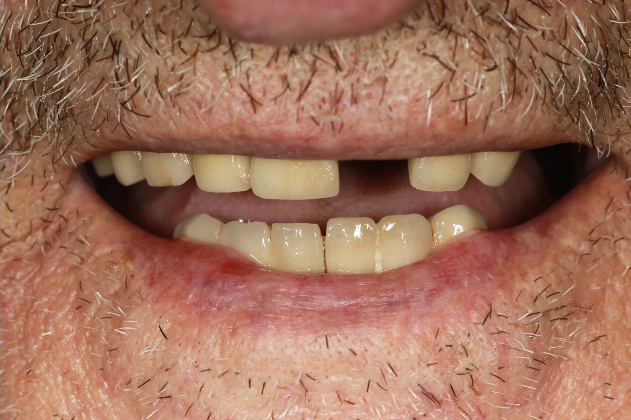 All on 6 — patient result — before