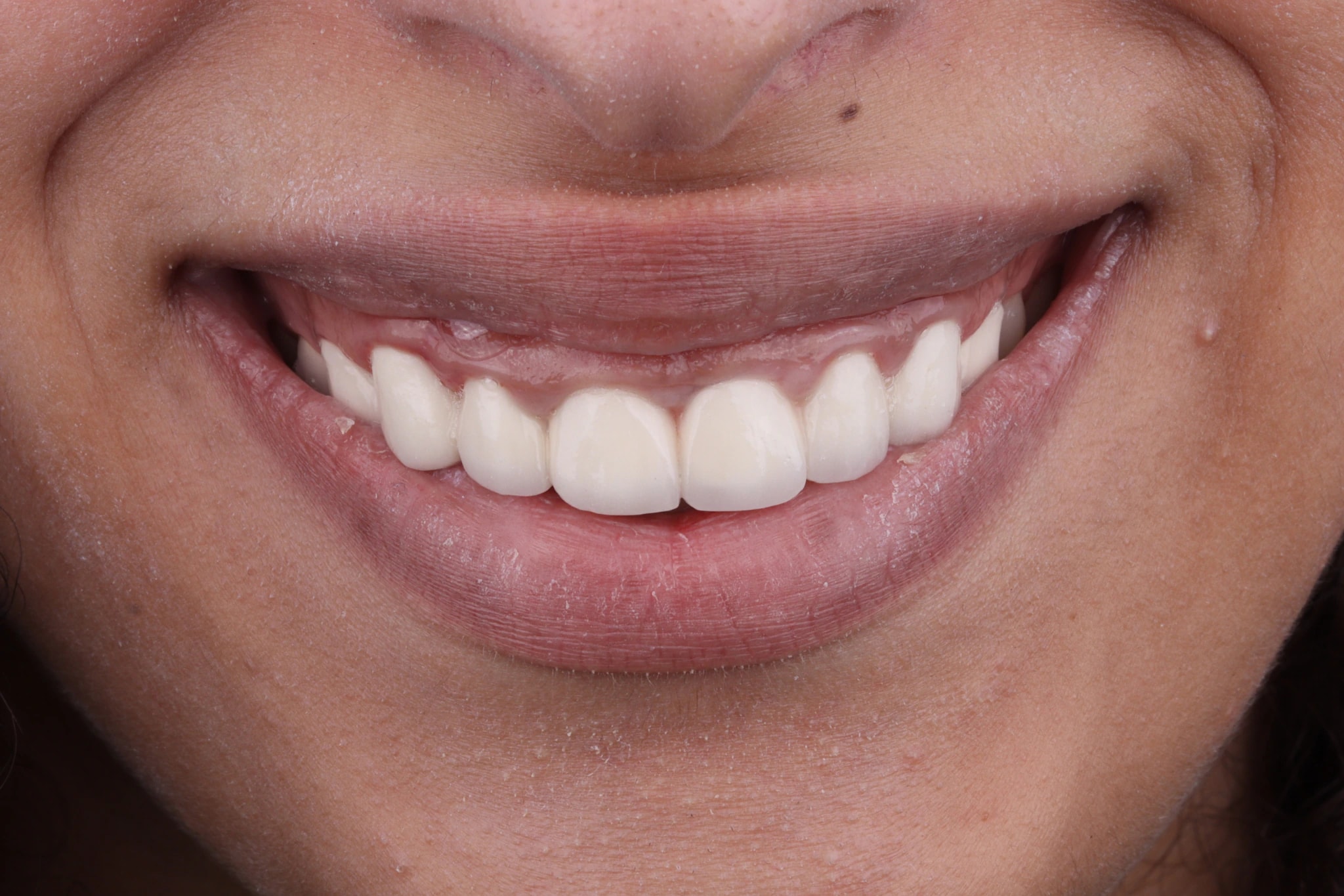 C&B & Gingivectomy — patient result — before