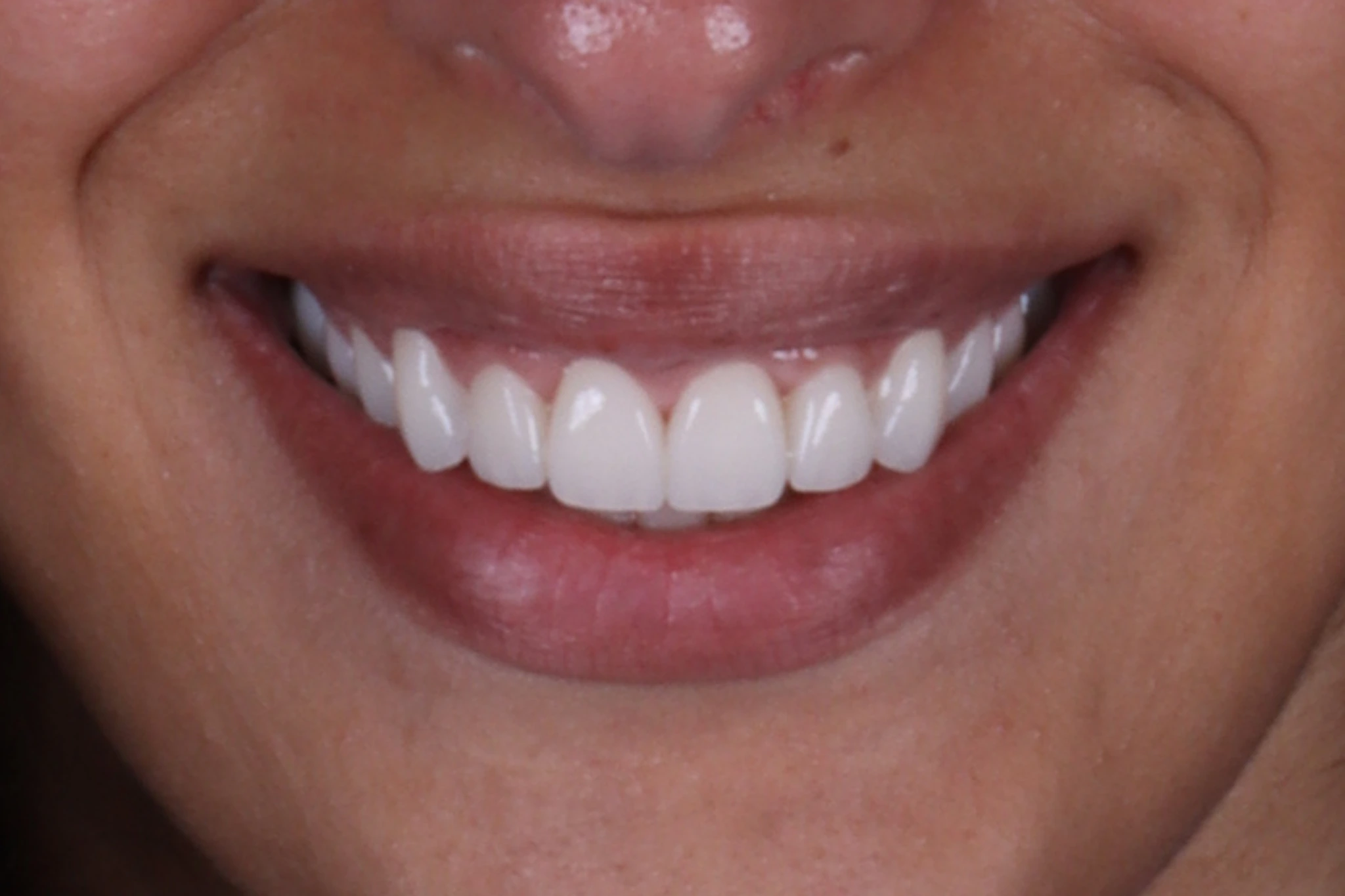 C&B & Gingivectomy — patient result — after