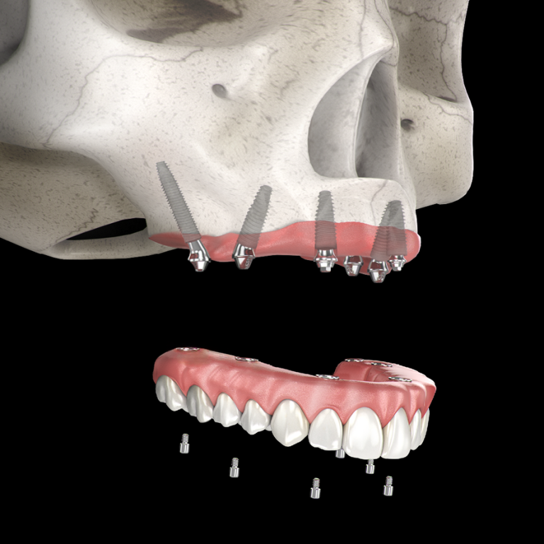 All on 4 converted to all on 6 FINAL FINAL