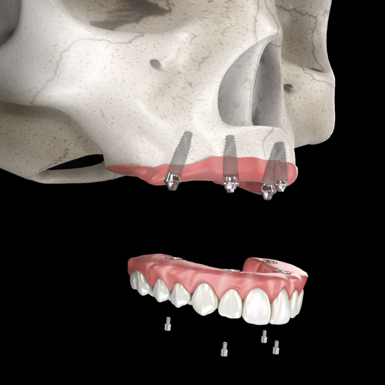 All on 4 og Full resolution