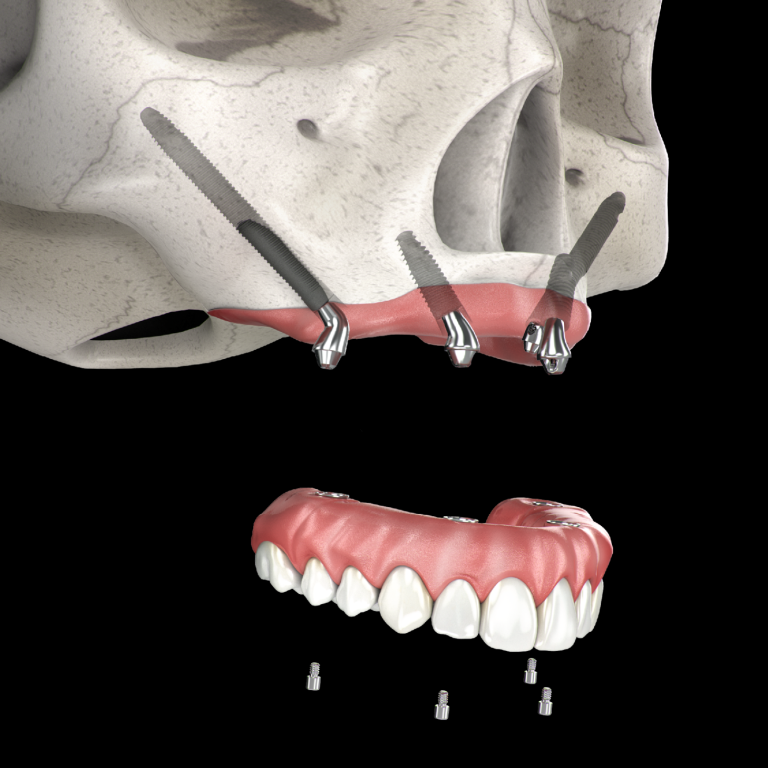 Zygoma og Full resolution