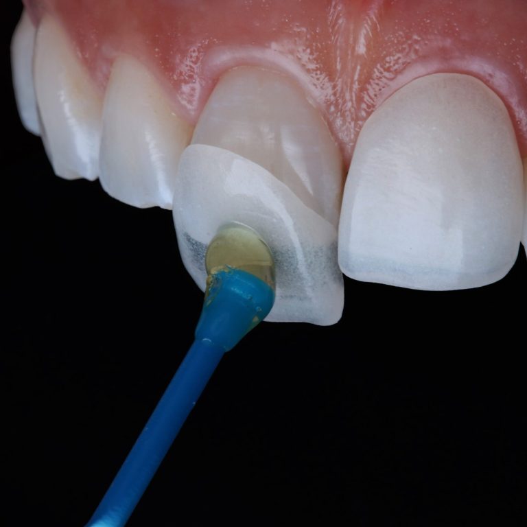 dental-veneers (1)